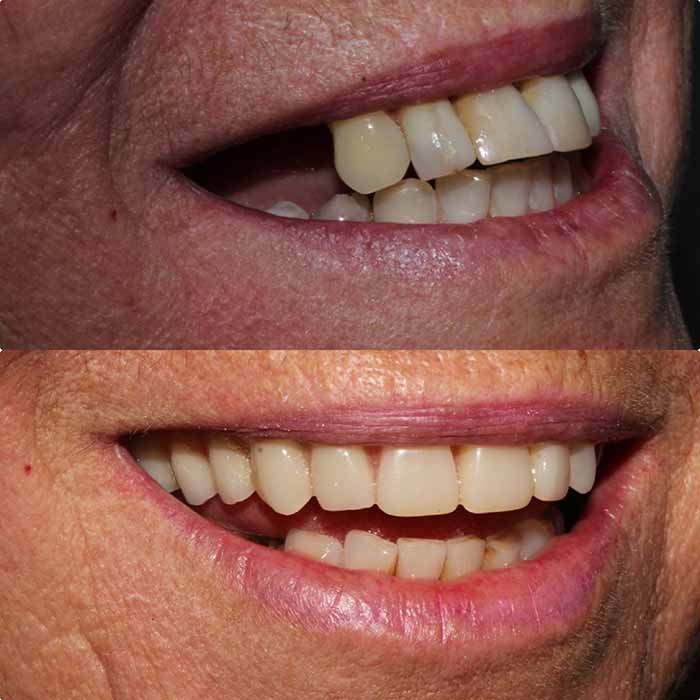 Especialistas em implantes dentários