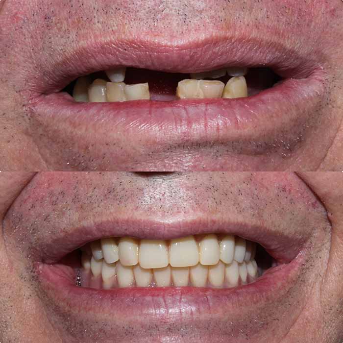 Dentista Implantes Dentários
