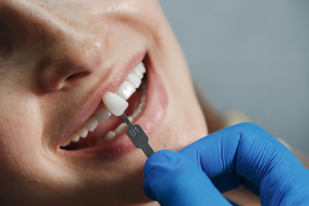 Dentista usa escala de cor para definir o tom ideal das lentes de contato dental de resina ou porcelana para paciente em Bauru.