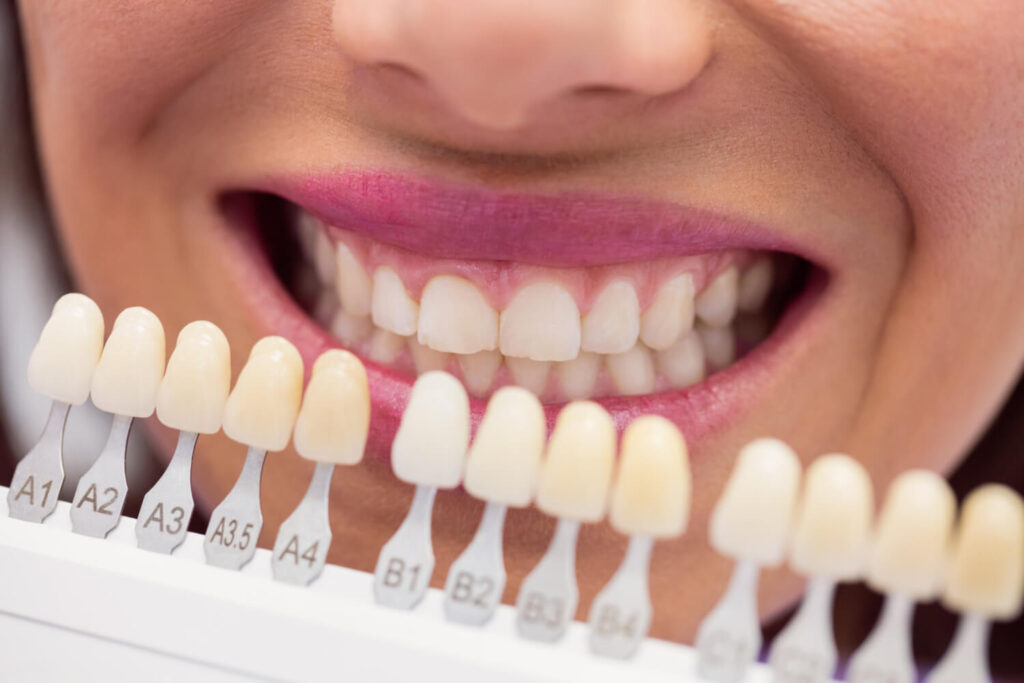 Close de sorriso feminino com escala de tonalidades para escolha das lentes de contato dental em porcelana na Lima Odontologia em Bauru.